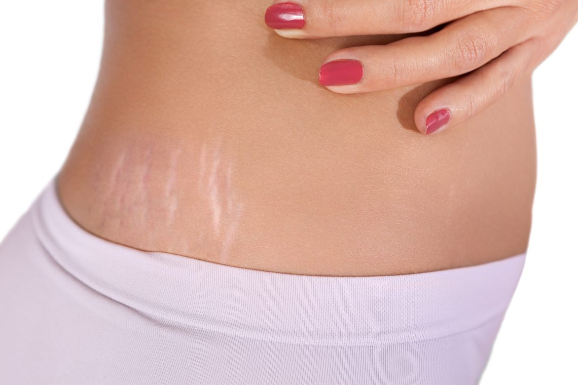 close up of stretch marks